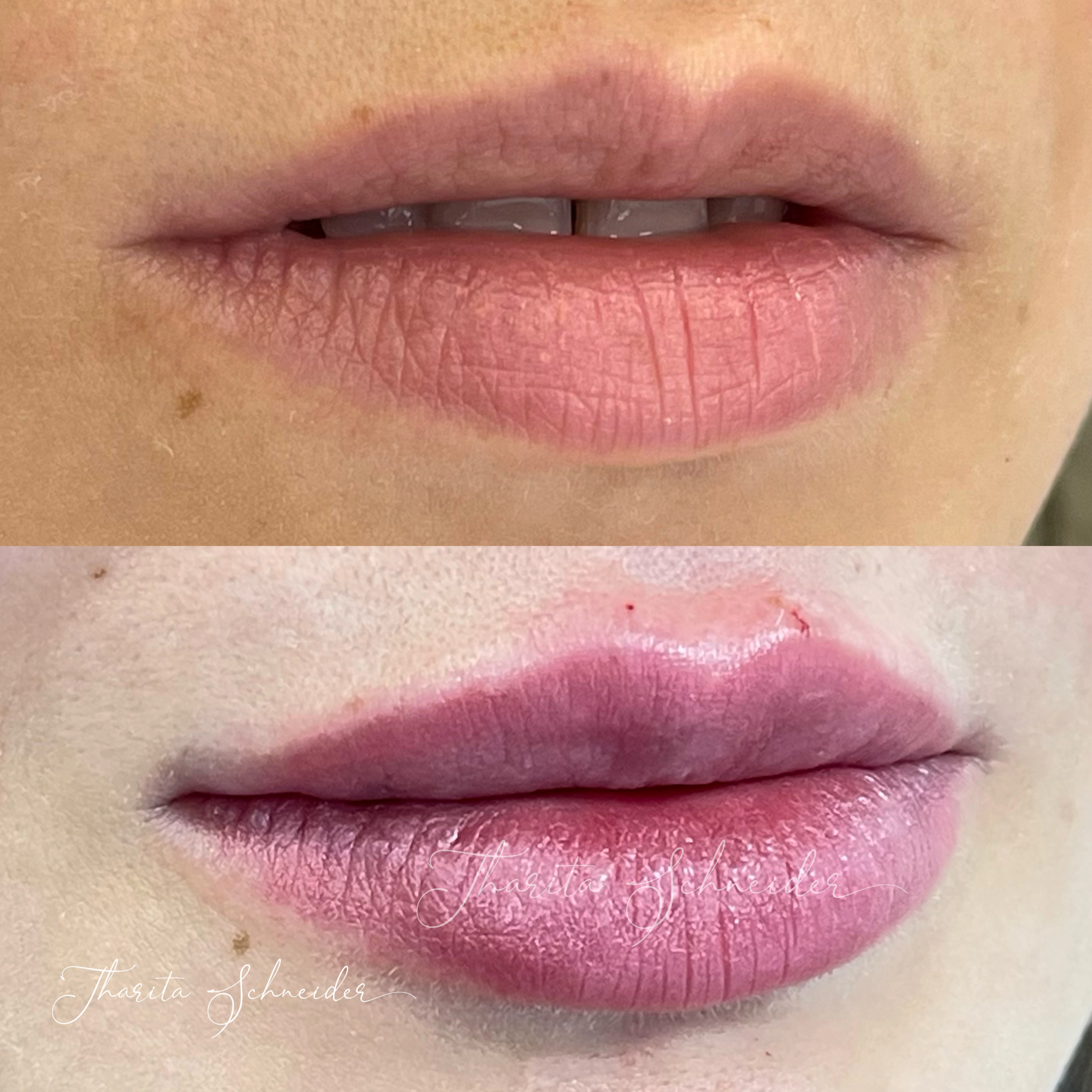 Preenchimento Labial